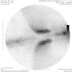 Scintigraphic scan of a normal SI joint